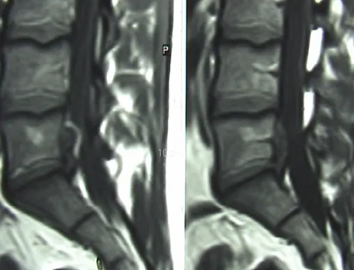 Before and After PL3D before treatment