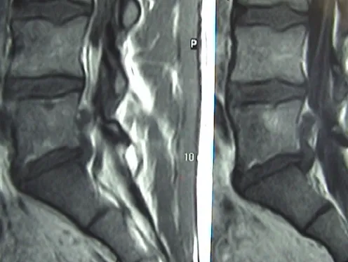 Before and After PL3D after treatment