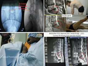 PL3D Laser Therapy: Advanced, Safe & Evidence -Based Proven Solution for Back and Neck Pain