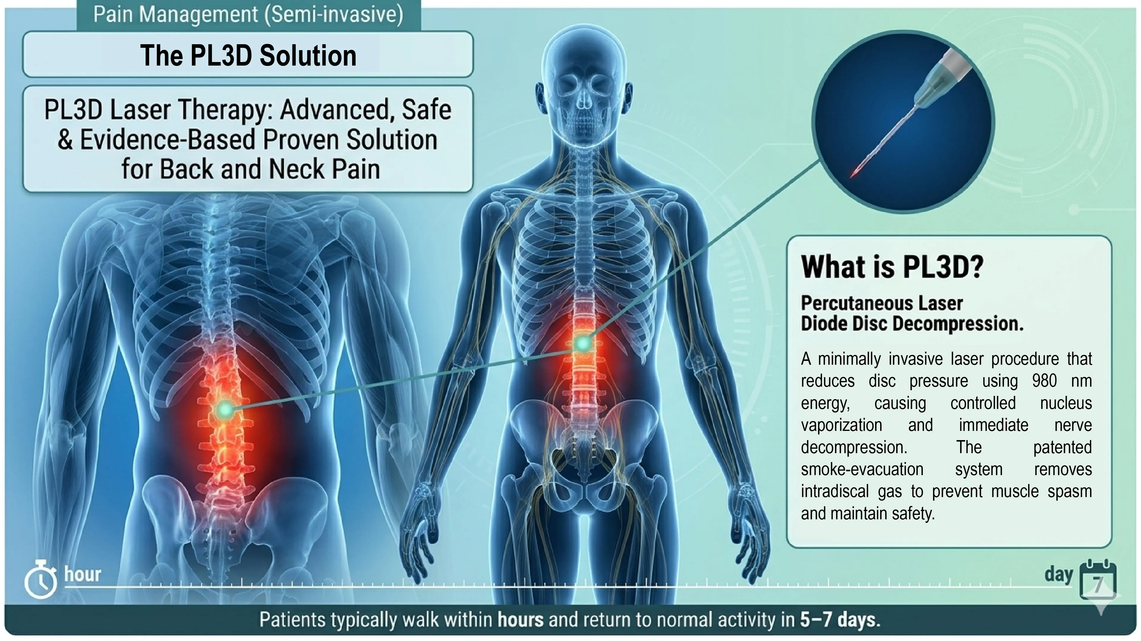 PL3D Percutaneous Laser - Diode Disc Decompression infographic