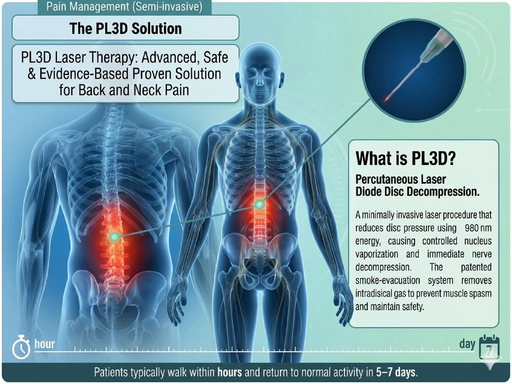PL3D Percutaneous Laser - Diode Disc Decompression infographic