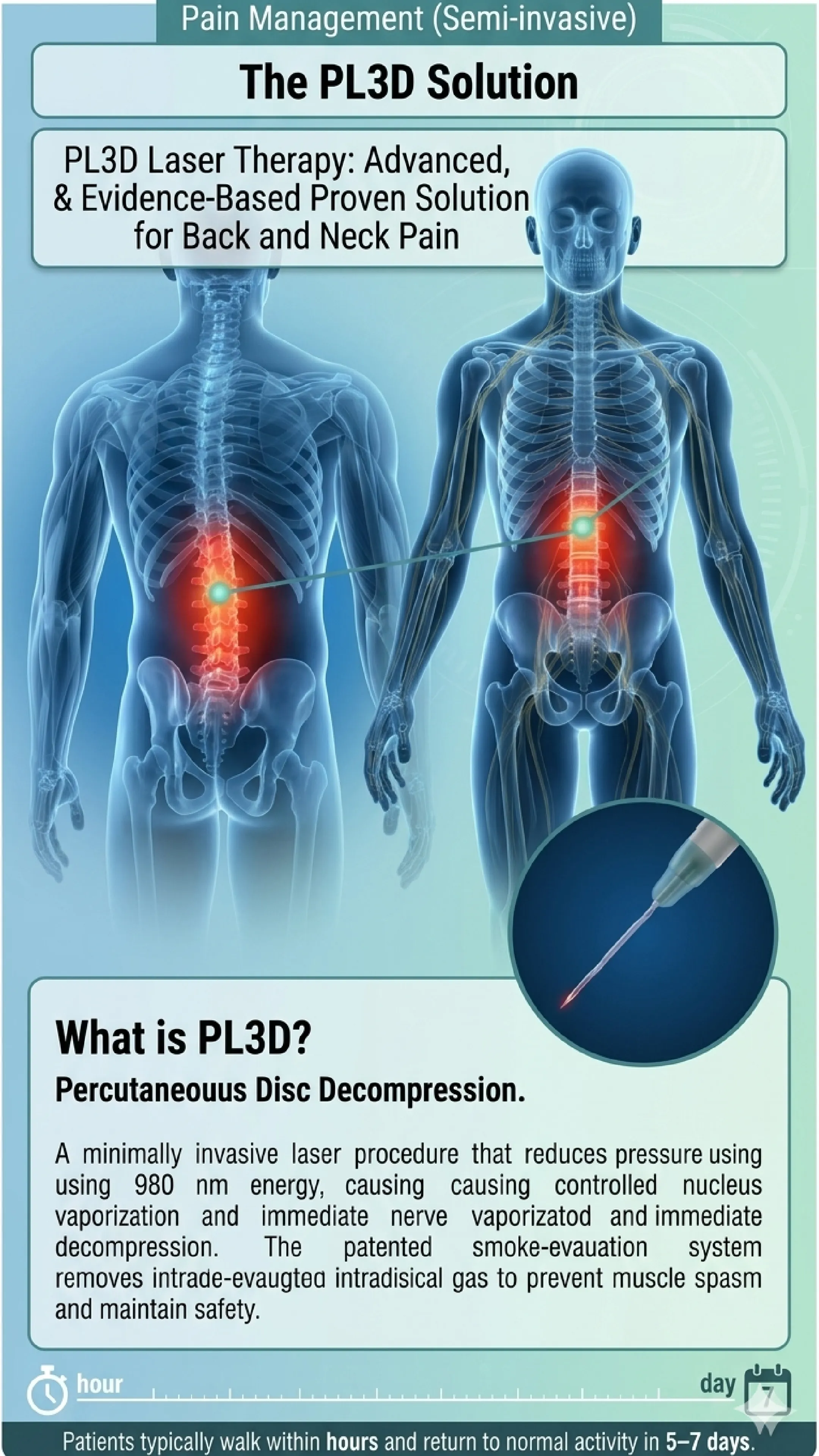 PL3D Percutaneous Laser - Diode Disc Decompression infographic