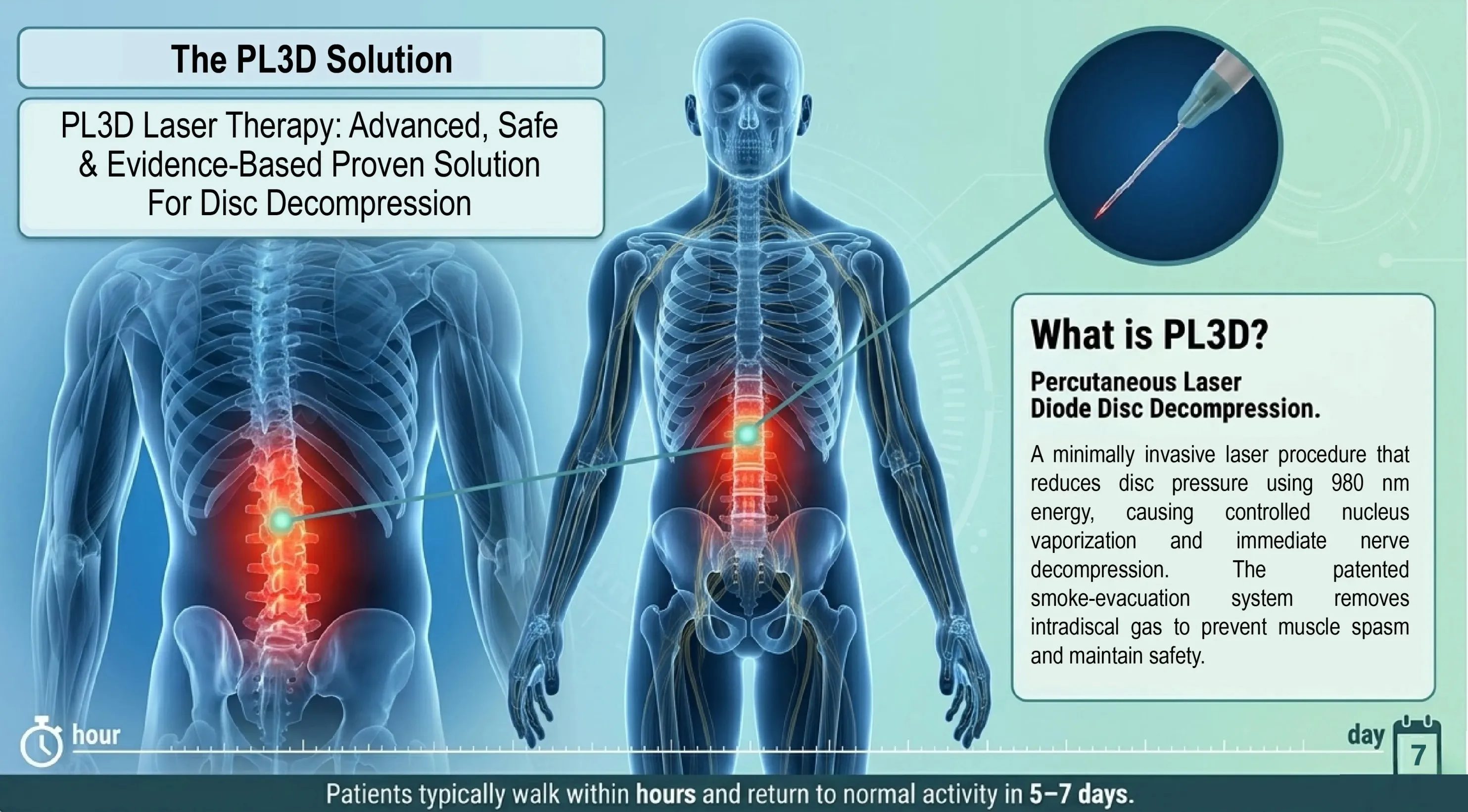 PL3D Percutaneous Laser - Diode Disc Decompression infographic