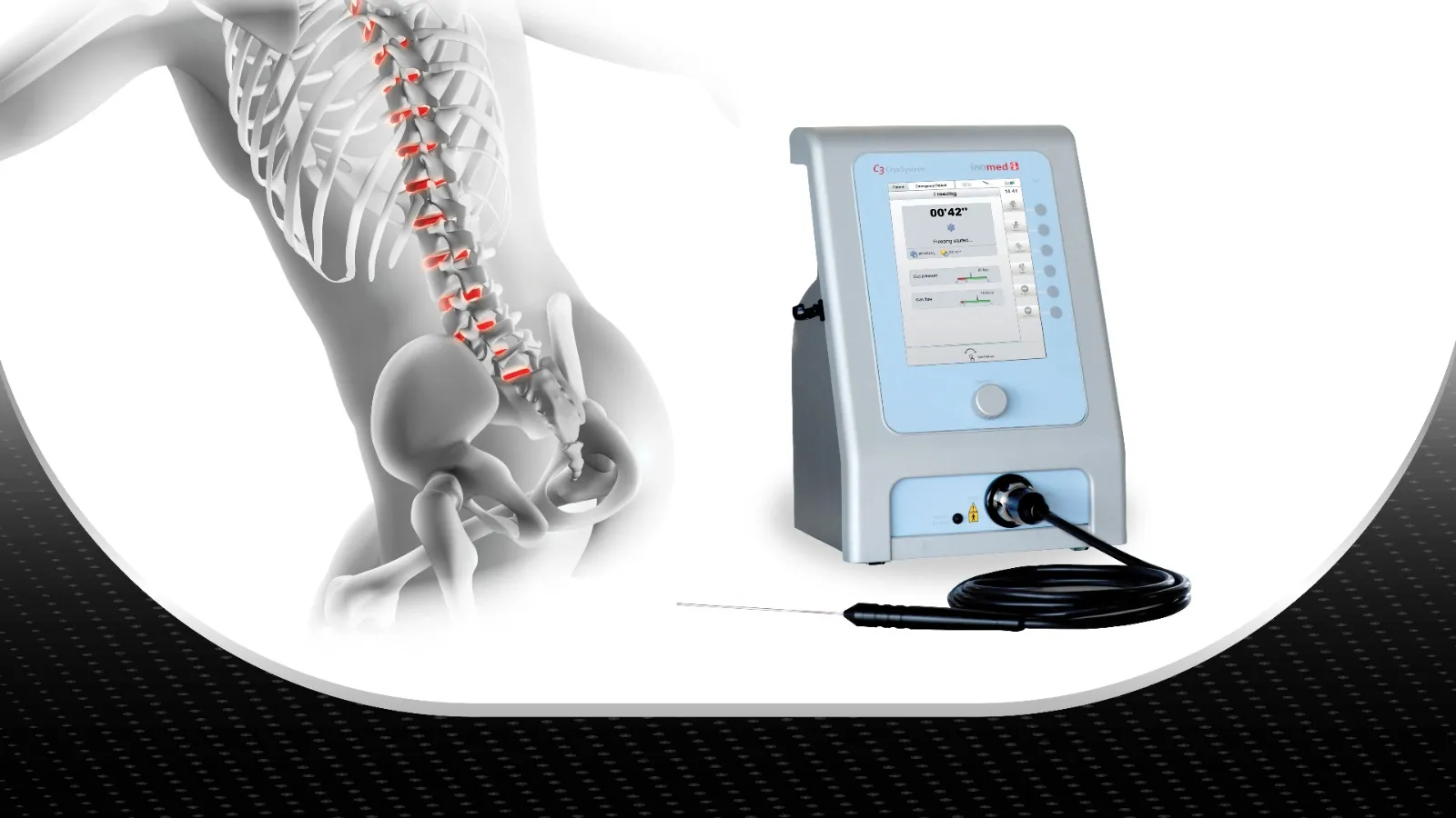 Cryo Ablation System